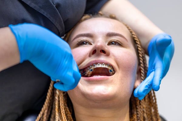Why more adults are choosing braces and aligners